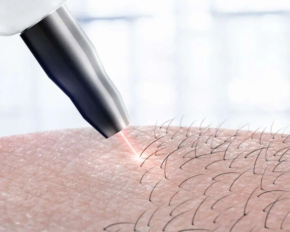 Guide to preparing for laser hair removal at Allurant Medical Spa