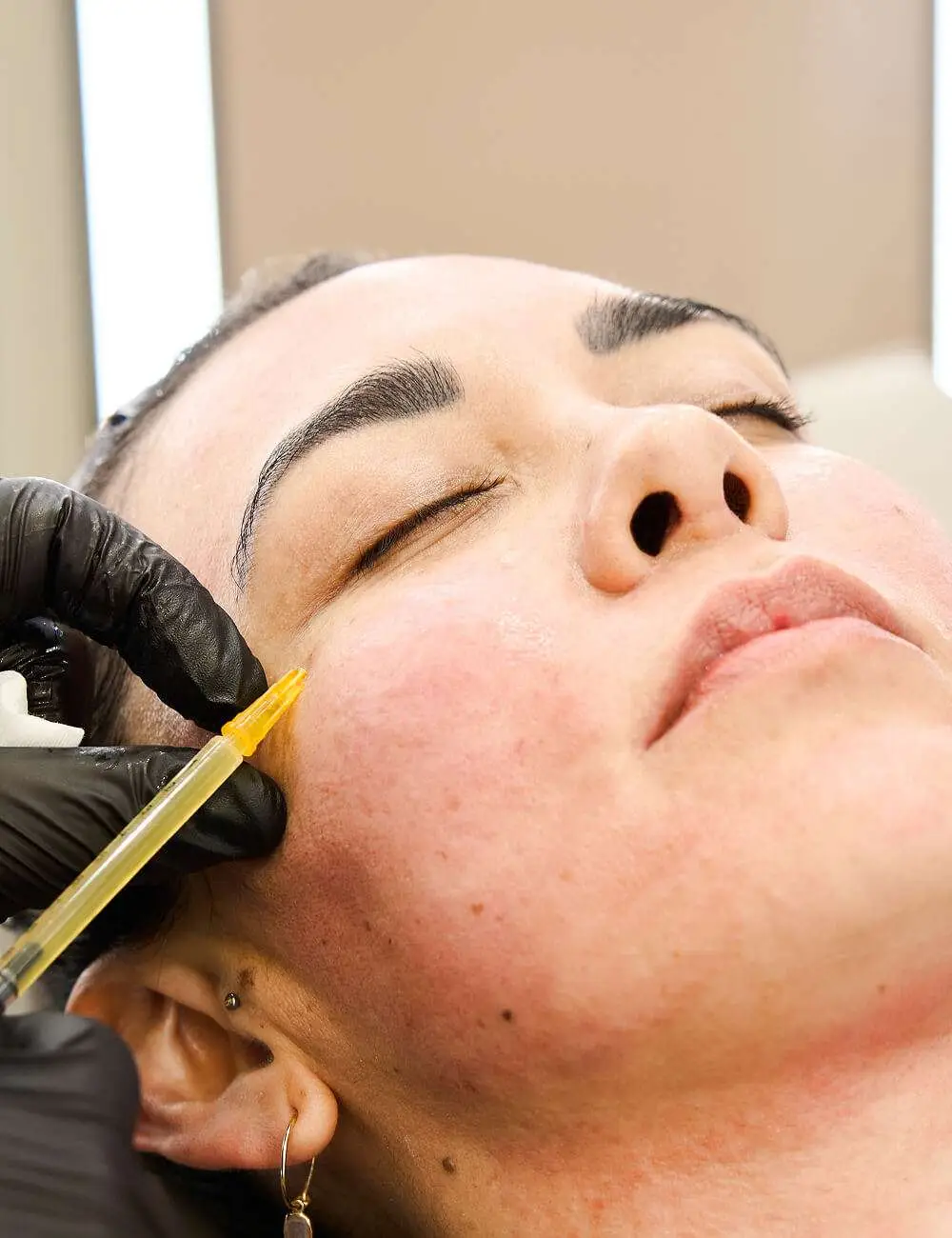 PRF full face injection San Diego natural collagen stimulation skin rejuvenation treatment Allurant Medical Spa