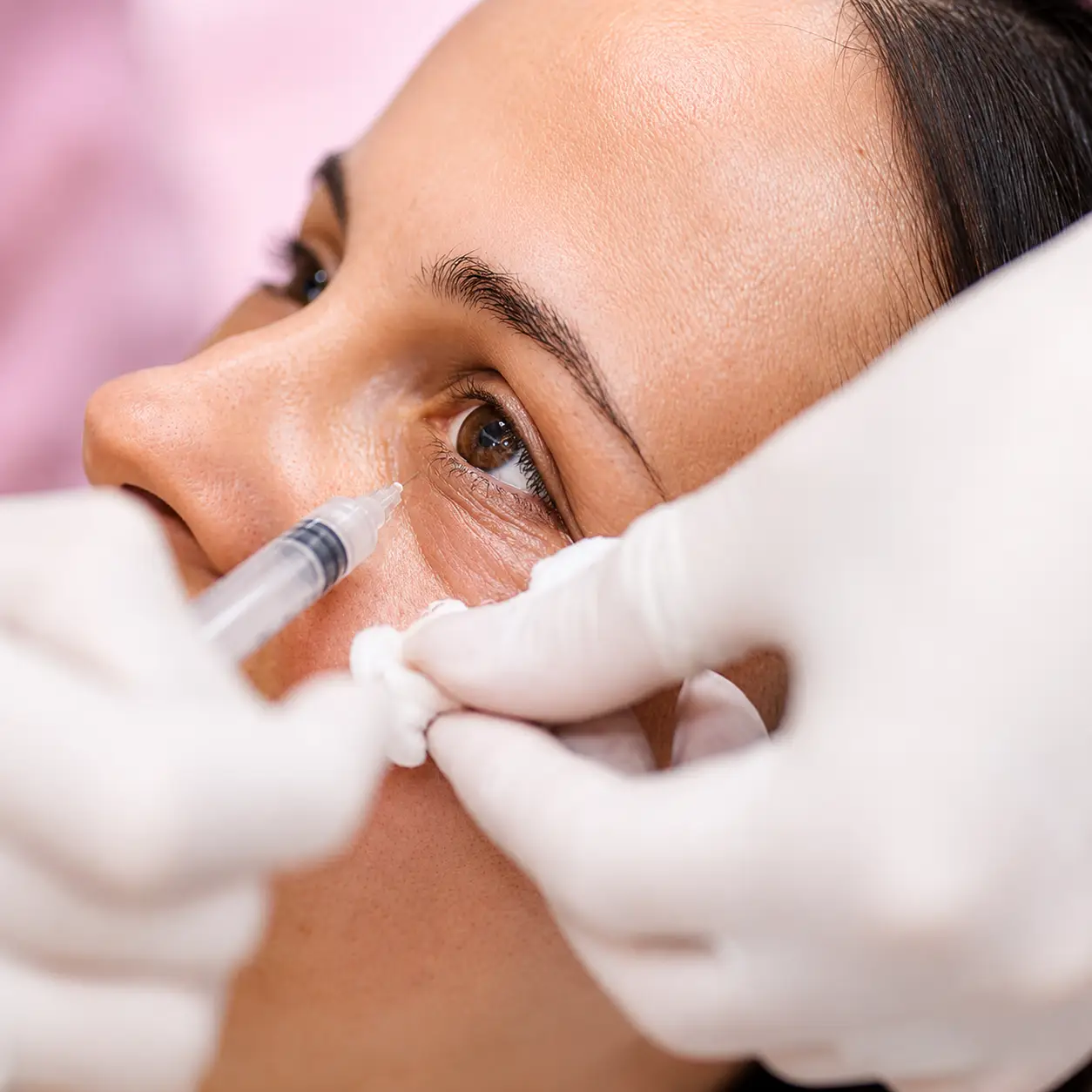 Personalized PRF Under Eyes treatment helping reduce under eye shadowing while improving skin tone and overall under eye rejuvenation.