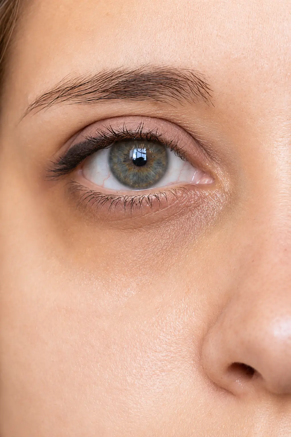 Patient with visible dark circles beneath the eyes before treatment illustrating pigmentation, thin skin, volume loss, and under eye shadowing.