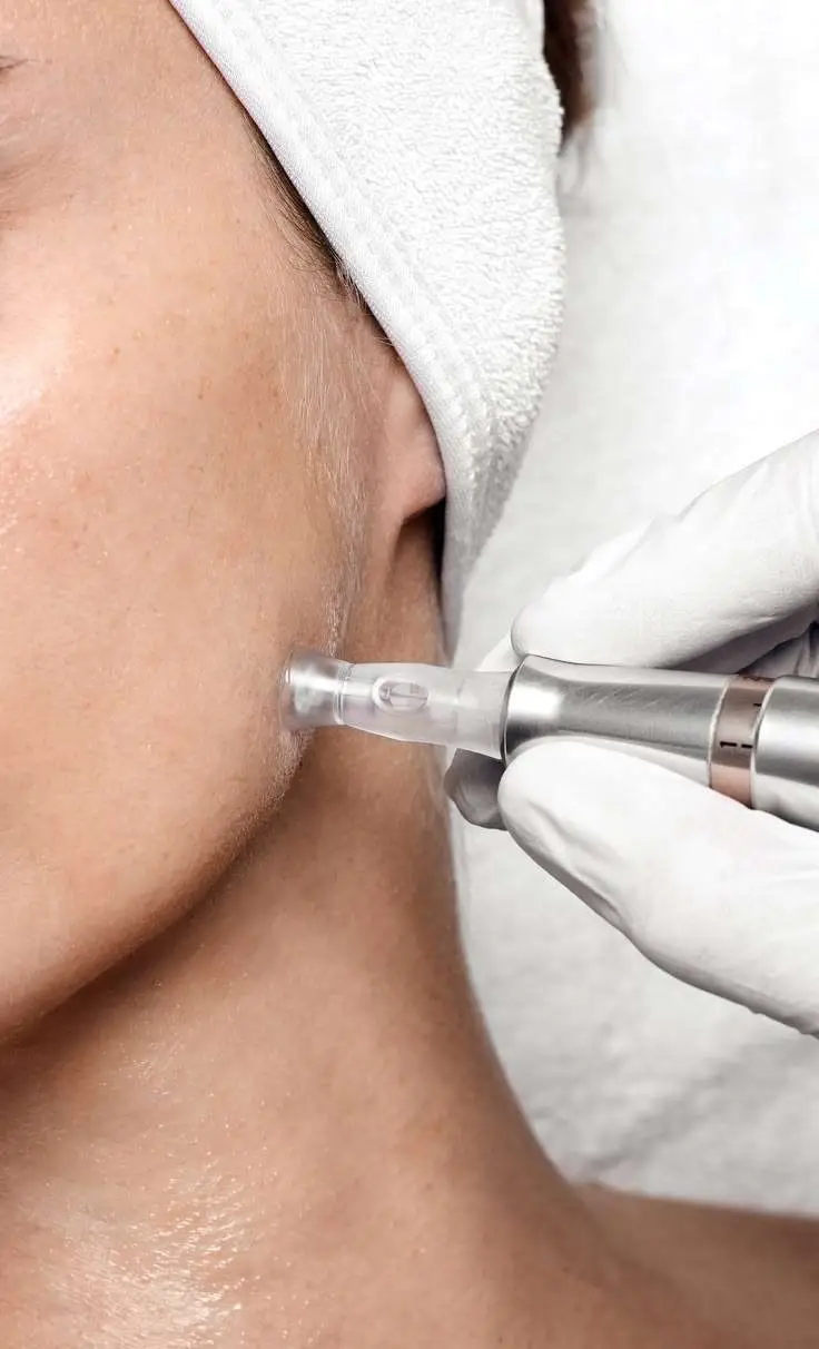 RF microneedling treatment to improve skin laxity and restore jawline definition in San Diego
