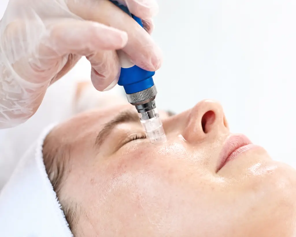 PRF microneedling treatment for under eye skin rejuvenation in San Diego