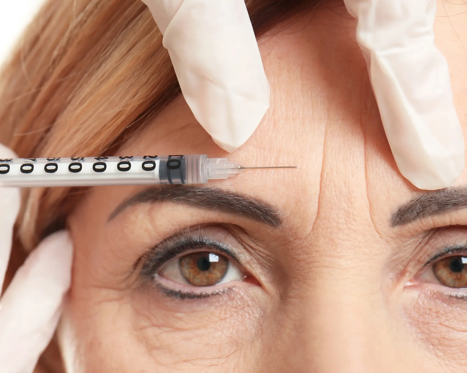 Botox vs Dysport comparison showing wrinkle relaxer treatment options in San Diego
