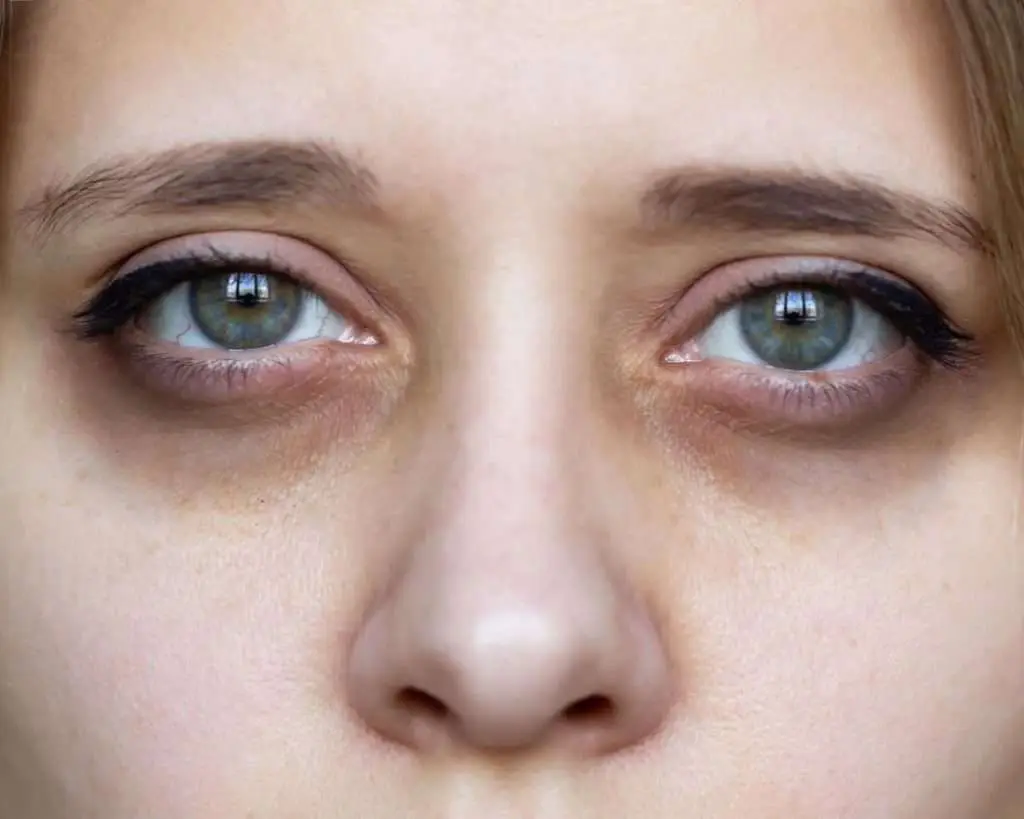 Genetic dark circles vs lifestyle dark circles guide, Allurant Medical Spa San Diego