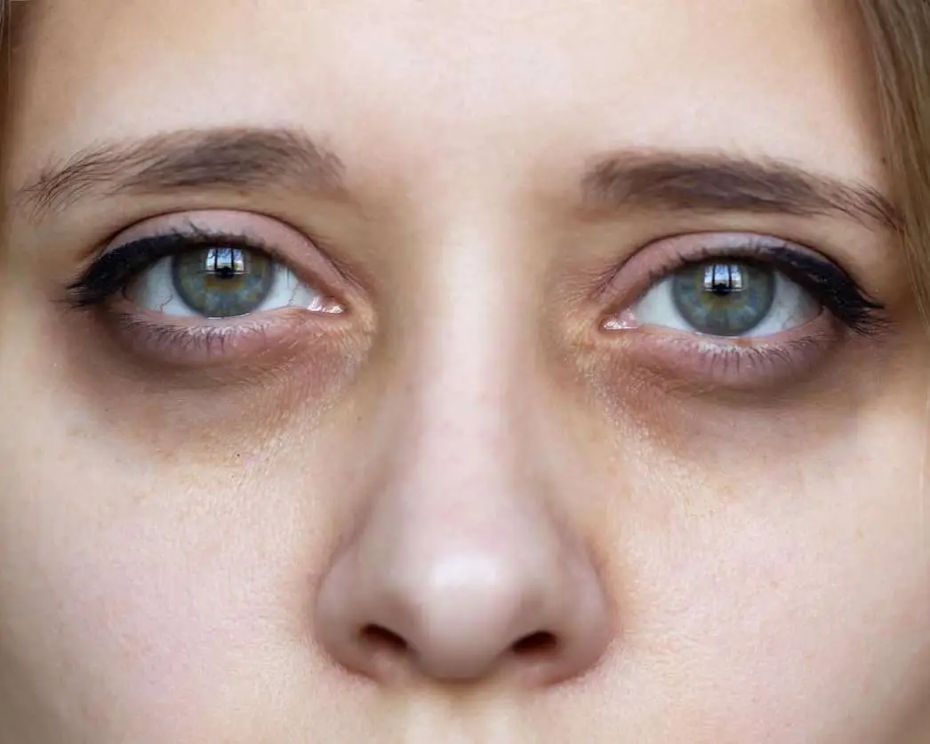 Genetic dark circles vs lifestyle dark circles guide, Allurant Medical Spa San Diego