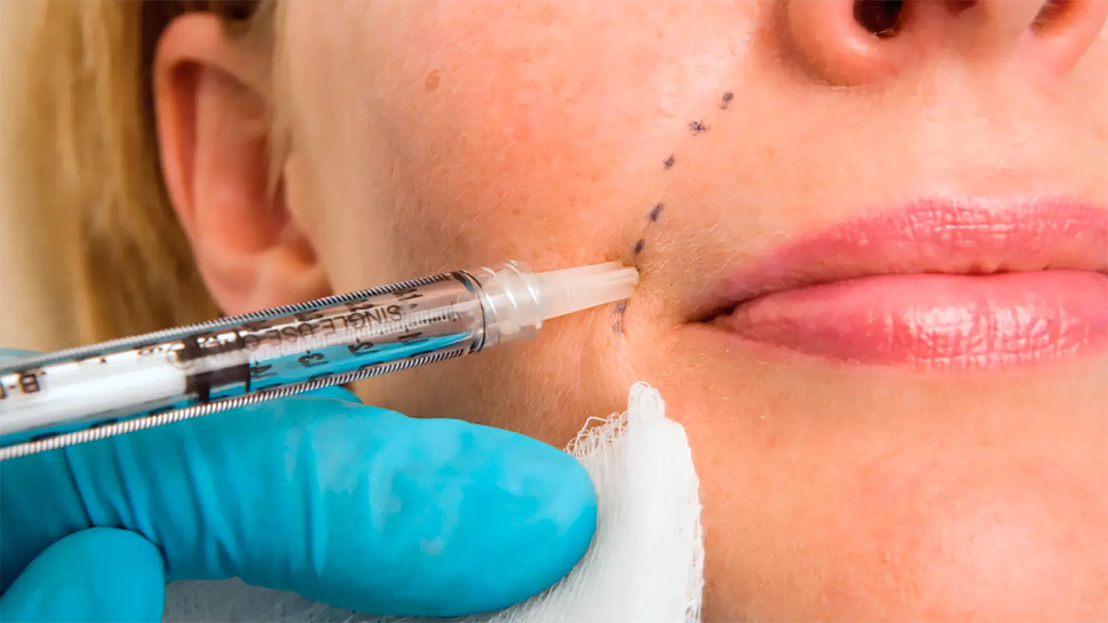 dermal filler nasolabial folds San Diego facial contouring smile lines facial balancing Allurant Medical Spa