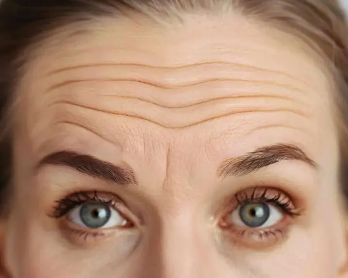 Dynamic Wrinkles vs Static Wrinkles before facial Botox San Diego treatment