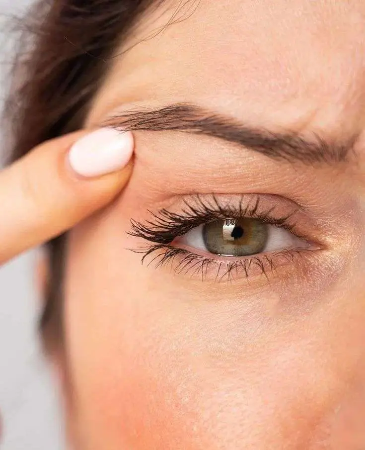 Dark circles hollow under eyes before PRF under eye treatment consultation Allurant Medical Spa San Diego