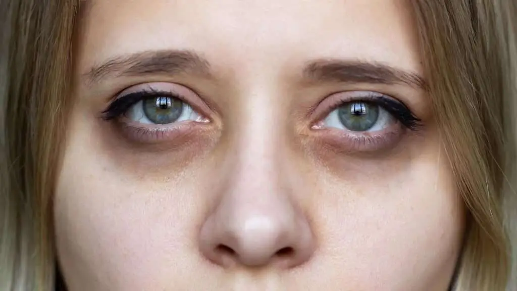 Comparison of genetic dark circles vs lifestyle dark circles under the eyes in San Diego