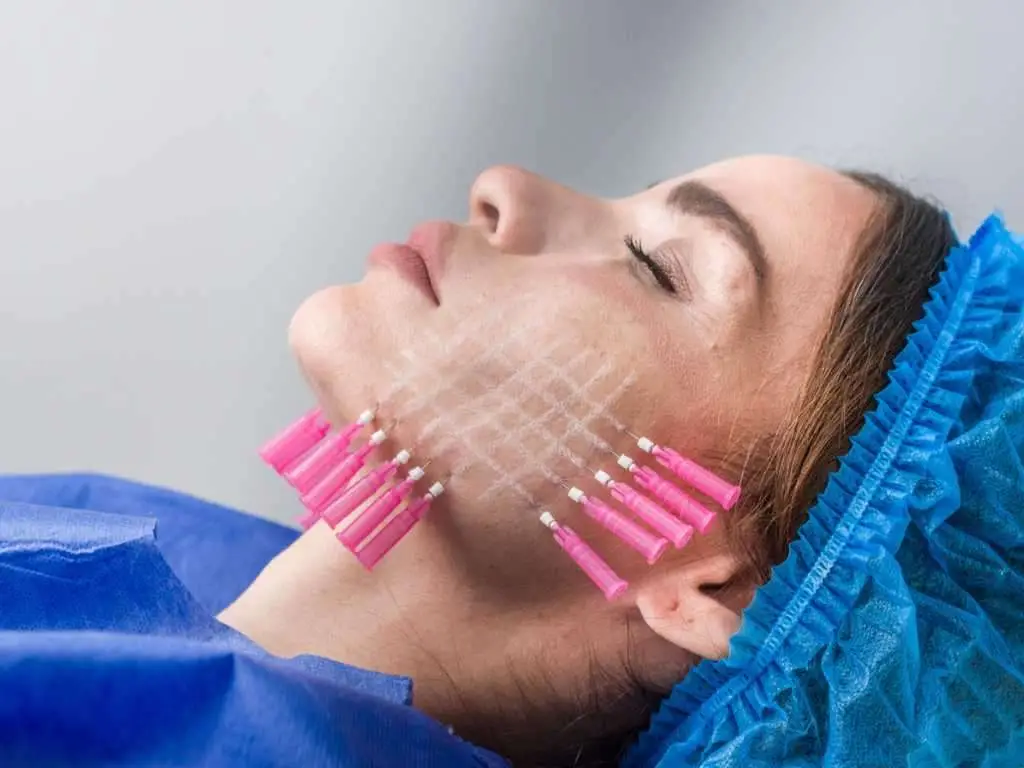 PDO thread treatment supporting jawline tissues to improve facial contour and skin firmness