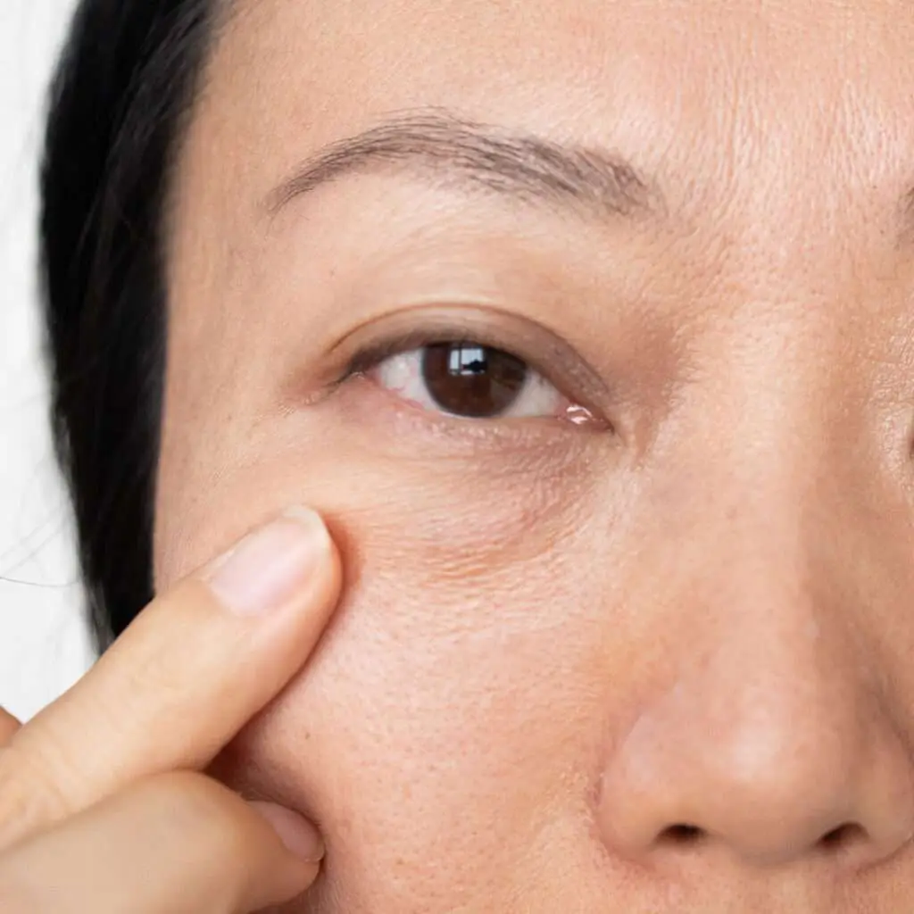 Woman examining under eye hollowing after rhinoplasty in mirror