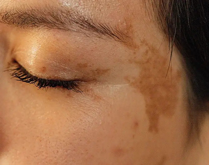 Woman examining melasma vs pigmentation dark spots on her cheek in the mirror