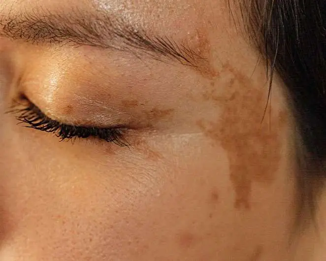 Close up of even, radiant skin after hyperpigmentation treatment San Diego results