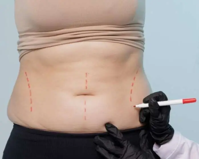 Laser liposuction for the abdomen San Diego treatment at Allurant Medical Spa