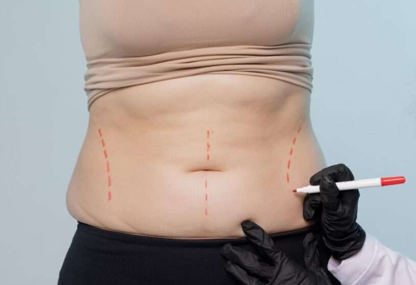 Woman consulting with provider about laser liposuction for the abdomen in San Diego