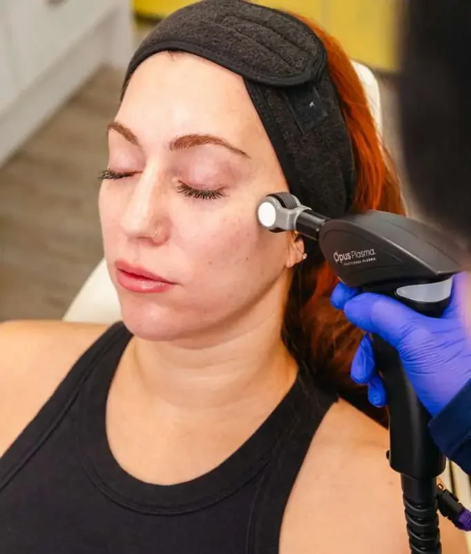 Woman receiving RF microneedling treatment for under eye skin texture in San Diego
