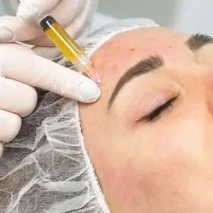 Woman with smooth, natural looking skin after PRF treatment in San Diego