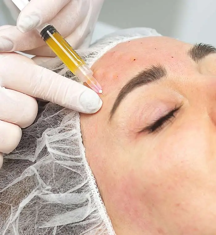 Woman with smooth, natural looking skin after PRF treatment in San Diego