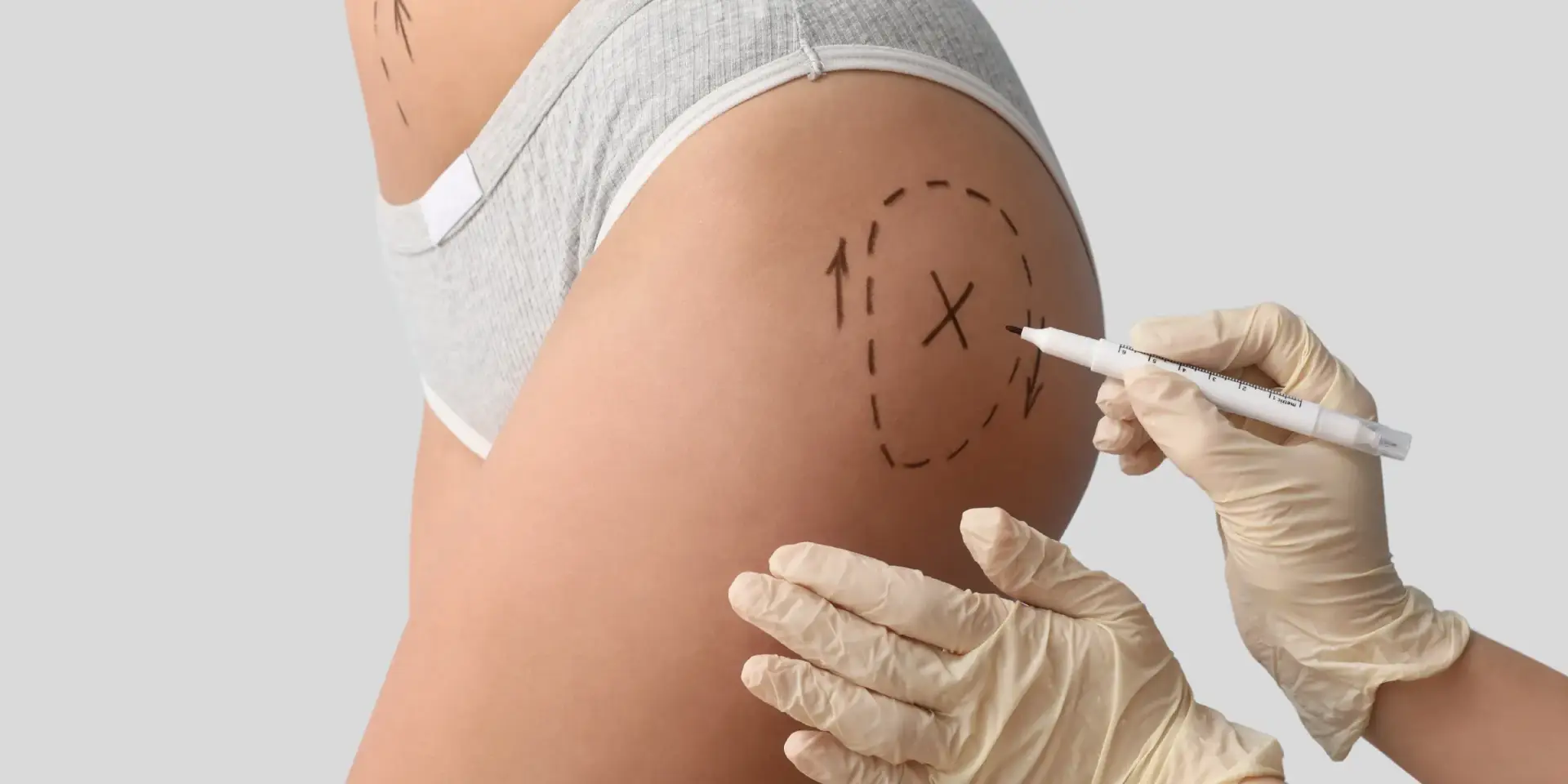 Woman consulting with provider about Radiesse vs Sculptra for butt enhancement San Diego options at Allurant Medical Spa
