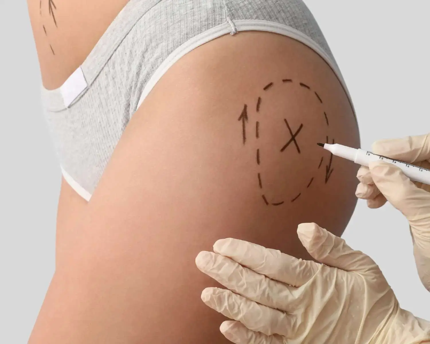 Radiesse vs Sculptra for butt enhancement San Diego comparison guide from Allurant Medical Spa