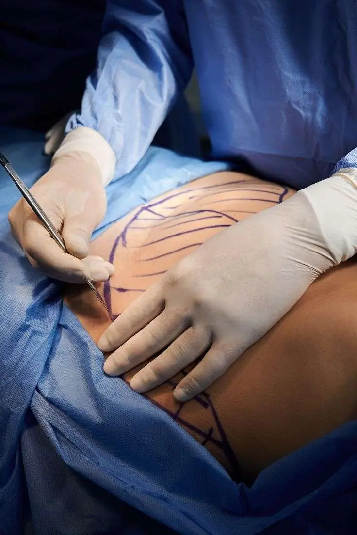 fat transfer procedure San Diego liposuction abdomen fat removal physician Dr Kat Allurant Medical Spa