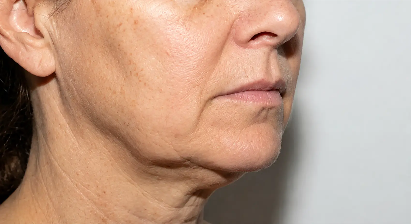 Woman with visible jowls and sagging skin along the jawline seeking jowl treatments in San Diego