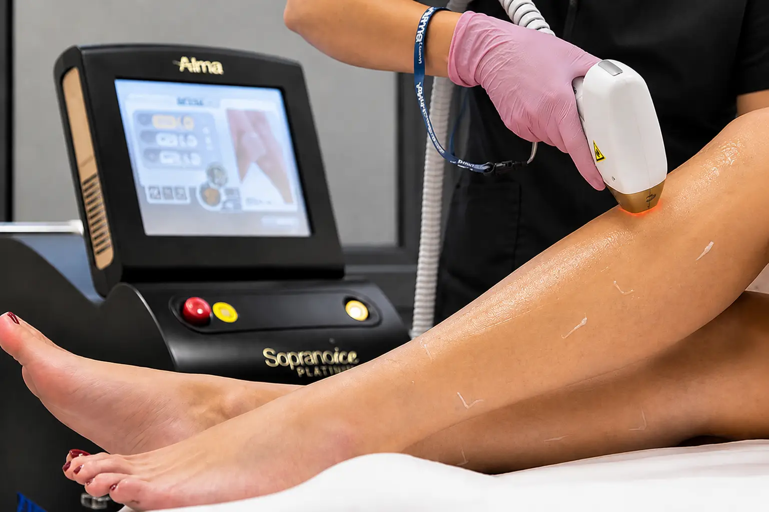 Soprano ICE Platinum laser hair removal treatment on a woman’s legs using SHR technology with integrated skin cooling