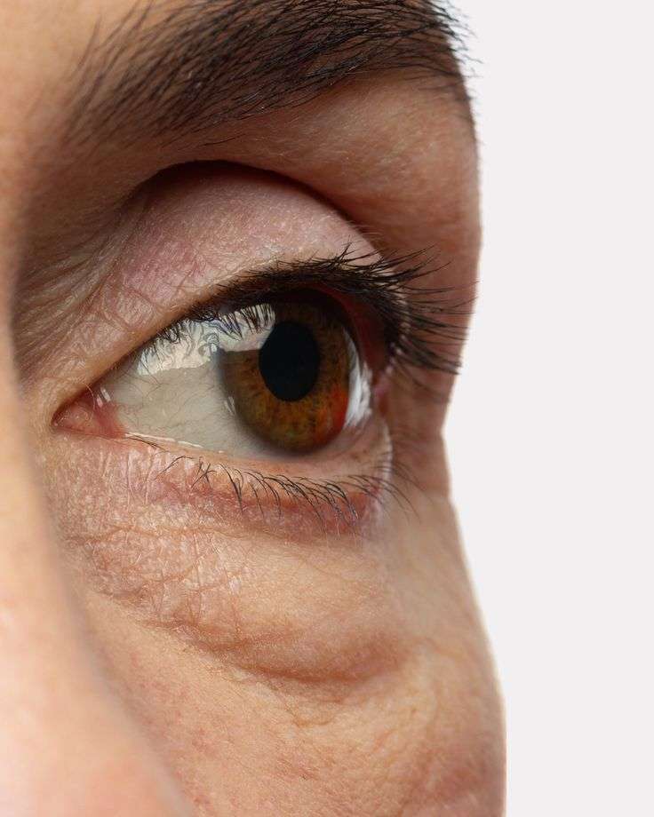 Visible under-eye bags showing puffiness and lower eyelid changes associated with aging, genetics, skin laxity, and fat pad changes