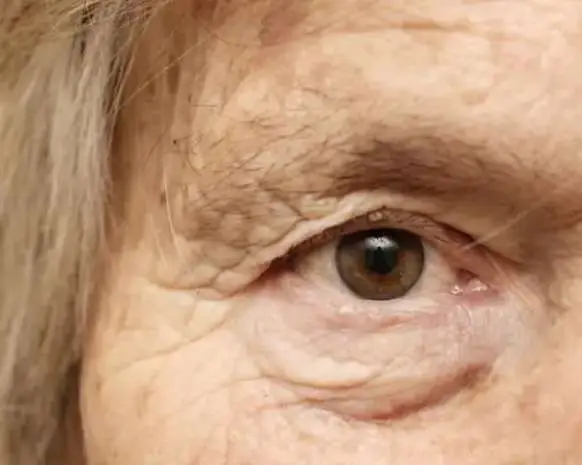 Woman's under eye area showing early aging under eyes caused by smoking and sun damage