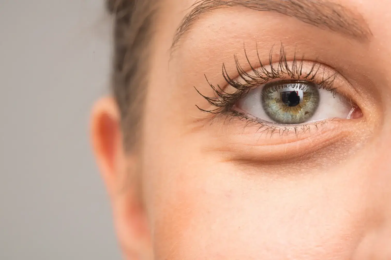 Eye bag treatments in San Diego for under-eye puffiness, skin laxity, and age-related changes at Allurant Medical Spa