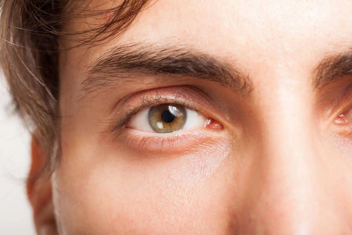 Woman's under eye area showing early aging under eyes caused by smoking and sun damage