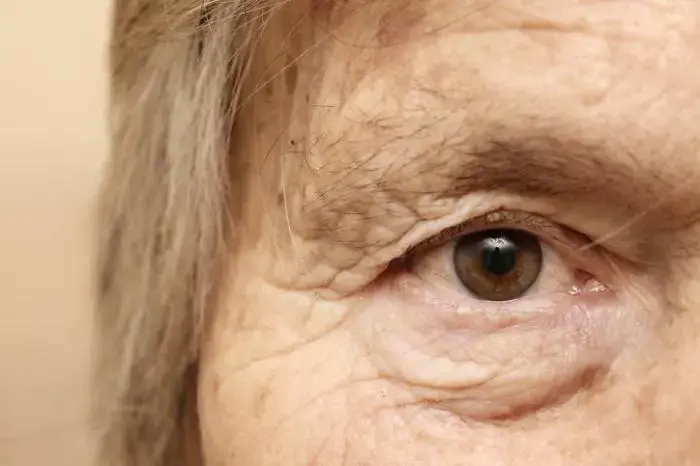 Close up of under eye skin showing signs of aging under eyes from sun exposure seeking under eye treatments